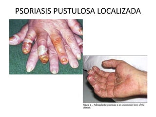 PSORIASIS PUSTULOSA LOCALIZADA 
 