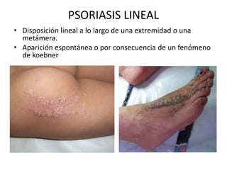 PSORIASIS LINEAL 
• Disposición lineal a lo largo de una extremidad o una 
metámera. 
• Aparición espontánea o por consecuencia de un fenómeno 
de koebner 
 