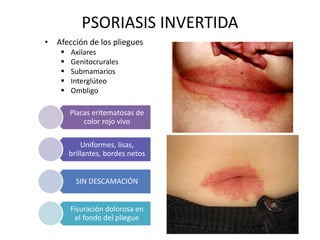 PSORIASIS INVERTIDA 
• Afección de los pliegues 
 Axilares 
 Genitocrurales 
 Submamarios 
 Interglúteo 
 Ombligo 
Placas eritematosas de 
color rojo vivo 
Uniformes, lisas, 
brillantes, bordes netos 
SIN DESCAMACIÓN 
Fisuración dolorosa en 
el fondo del pliegue 
 