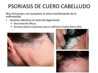 PSORIASIS DE CUERO CABELLUDO 
Muy frecuente y en ocasiones la única manifestación de la 
enfermedad. 
• Lesiones idénticas al resto del tegumento 
 Descamación difusa 
 Gruesas placas escamosas que se adhieren al pelo (falsa tiña) 
 