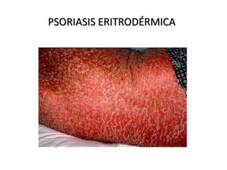 PSORIASIS ERITRODÉRMICA 
 