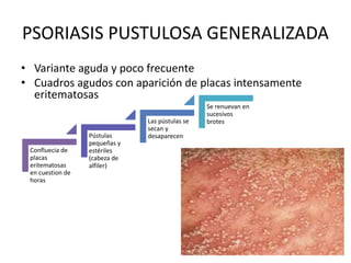 PSORIASIS PUSTULOSA GENERALIZADA 
• Variante aguda y poco frecuente 
• Cuadros agudos con aparición de placas intensamente 
eritematosas 
Confluecia de 
placas 
eritematosas 
en cuestion de 
horas 
Pústulas 
pequeñas y 
estériles 
(cabeza de 
alfiler) 
Las pústulas se 
secan y 
desaparecen 
Se renuevan en 
sucesivos 
brotes 
 