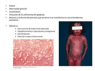 • Fiebre 
• Mal estado general 
• Leucocitosis 
• Elevación de la sedimentación globular 
• Retorno a la forma de psoriasis que ya tenía ó se transforma en una eritrodermia 
psoriásica 
• Mortal sí: 
 Hay ausencia de tratamiento adecuado 
 Hipoalbuminemia e hipocalcemia consiguiente 
 Deshidratación 
 Infección y sepsis intercurrente 
 