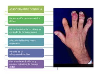 ACRODERMATITIS CONTINUA 
Rara erupción pustulosa de los 
dedos 
Inicia alrededor de las uñas y se 
extiende de forma proximal 
Afección del lecho y matriz 
ungueales 
Pérdida de las 
uñas/onicodistrofias 
En casos de evolución muy 
cronica: osteólisis de falange 
distal 
 