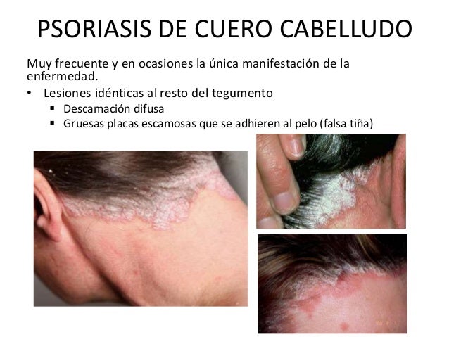 La psoriasis y sus tipos de la foto