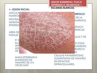  LESION INICIAL:
MACULARES
PUNTIFORMES
INFILTRADOS
MONONUCLEARES EN
EPIDERMIS
AREA DE UNA O DOS
PAPILAS
 LESION EN DESARROLLO:
AUMENTO DE 50% DE LA
DERMIS (ENGROSAMIENTO)
AUMENTO DE LA
ACTIVIDAD METABOLICA
DE CELULAS EPIDERMICAS
AUMENTO DE CELULAS T DE
LA DERMIS
IDENTIFICACION DE ZONA
MARGINAL CON AUMENTO
DE ESPESOR EPIDERMISCO
+ HIPERQUERATOSIS
CELULAS PAVIMENTOSAS
AUMENTADAS DE TAMAÑO
EN ESPACIOS
EXTRACELULARES.
 LESION MADURA:
ELONGACION
UNIFORME CON
ADELGAZAMIENTO
DE EPIDERMIS
MASA EPIDERMICA
AUMENTAD DE
TAMAÑO DE 3-5
VECES MAS
LESION ELEMENTAL: PLACA
HIPEREMICA DELIMITADA +
ESCAMAS BLANCAS
 