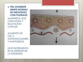  PIEL APARENTE
MENTE NORMAL
DE INDIVIDUOS
CON PSORIASIS
MANIFIESTA LEVE
CURVATURA Y
DILATACION
CAPILAR
AUMENTO DE
CEL´S
MONONUCLEARES
Y MASTOIDEAS
LEVE INCREMENTO
EN EL ESPESOR DE
LA EPIDERMIS
 