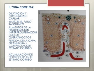  ZONA COMPLETA:
DILATACION Y
TORTUOSIDAD
CAPILAR
10VECES EL FLUJO
SANGUINEO
AUMENTO9 DE LA
PROLIFERACION
(HIPERPROLIFERACION
) DE LOS
QUERATINOCITOS
PERDIDA DE LA CAPA
GRANULOSA +
COMPACTACION
ESTRATO CORNEO
ACUMULACION DE
NEUTROFILOS EN EL
ESTRATO CORNEO
 