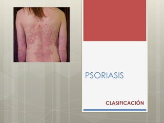 PSORIASIS
CLASIFICACIÓN
 