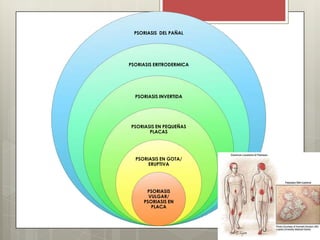 PSORIASIS DEL PAÑAL
PSORIASIS ERITRODERMICA
PSORIASIS INVERTIDA
PSORIASIS EN PEQUEÑAS
PLACAS
PSORIASIS EN GOTA/
ERUPTIVA
PSORIASIS
VULGAR/
PSORIASIS EN
PLACA
 