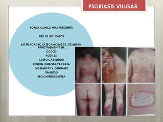 FORMA CLINICA MAS FRECUENTE
90% DE LOS CASOS
LAS PLACAS ROJO ESCAMOSAS SE LOCALIZAN
PRINCIPALMENTE EN:
CODOS
RODILLS
CUERO CABELLUDO
REGION LUMBOSACRA BAJA
LAS NALGAS Y GENITALES
OMBLIGO
REGION INTERGLUTEA
PSORIASIS VULGAR
 