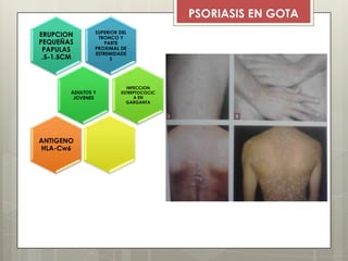 PSORIASIS EN GOTA
SUPERIOR DEL
TRONCO Y
PARTE
PROXIMAL DE
ESTREMIDADE
S
ERUPCION
PEQUEÑAS
PAPULAS
.5-1.5CM
ADULTOS Y
JOVENES
INFECCION
ESTREPTOCOCIC
A EN
GARGANTA
ANTIGENO
HLA-Cw6
 