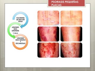 PSORIASIS PEQUEÑAS
PLACAS
PACIENTES
DE MAYOR
EDAD
LESIONES
MAS
GRANDES
1-2cm
LESIONES
MAS GRUESA
Y
ESCAMOSAS
 