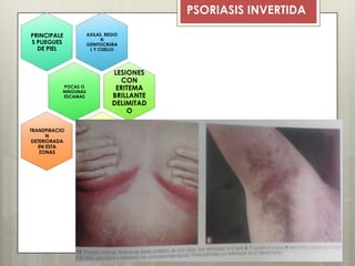 PSORIASIS INVERTIDA
AXILAS, REGIO
N
GENITOCRURA
L Y CUELLO
PRINCIPALE
S PLIEGUES
DE PIEL
POCAS O
NINGUNAS
ESCAMAS
LESIONES
CON
ERITEMA
BRILLANTE
DELIMITAD
O
TRANSPIRACIO
N
DETERIORADA
EN ESTA
ZONAS
 
