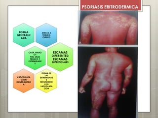 PSORIASIS ERITRODERMICA
AFECTA A
TODO EL
CUERPO
FORMA
GENERALIZ
ADA
CARA, MANO
S Y
PIES, UÑAS
TRONCO Y
EXTREMIDADE
S
ESCAMAS
DIFERENTES:
ESCAMAS
SUPERFICIALES
EDEMA DE
LAS
EXTREMIDADE
S
SECUNDARIO
A LA
VASODILATA
CION
VASODILATA
CION
GENERALIZAD
A
 