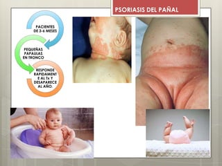 PSORIASIS DEL PAÑAL
PACIENTES
DE 3-6 MESES
PEQUEÑAS
PAPAULAS
EN TRONCO
RESPONDE
RAPIDAMENT
E AL Tx Y
DESAPARECE
AL AÑO.
 