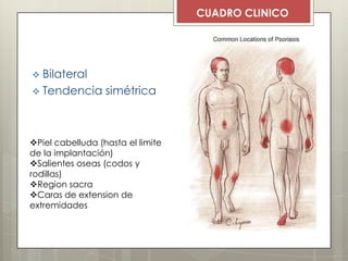  Bilateral
 Tendencia simétrica
Piel cabelluda (hasta el limite
de la implantación)
Salientes oseas (codos y
rodillas)
Region sacra
Caras de extension de
extremidades
CUADRO CLINICO
 