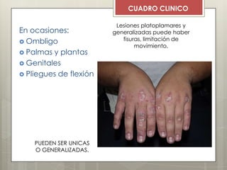 En ocasiones:
 Ombligo
 Palmas y plantas
 Genitales
 Pliegues de flexión
PUEDEN SER UNICAS
O GENERALIZADAS.
Lesiones platoplamares y
generalizadas puede haber
fisuras, limitación de
movimiento.
CUADRO CLINICO
 