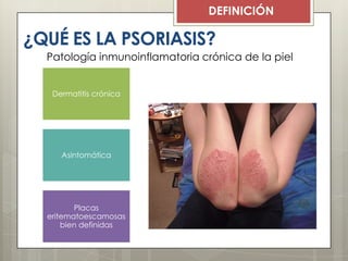 ¿QUÉ ES LA PSORIASIS?
DEFINICIÓN
Patología inmunoinflamatoria crónica de la piel
Dermatitis crónica
Asintomática
Placas
eritematoescamosas
bien definidas
 