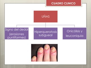 UÑAS
Signo del dedal
(erosiones
puntiformes)
Hiperqueratosis
subgueal
Onicólisis y
leuconiquia
CUADRO CLINICO
 