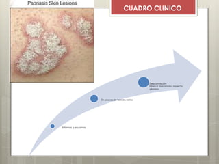 Eritemas y escamas
En placas de bordes netos
Descamación
blanca, nacarada, aspecto
yesosos
CUADRO CLINICO
 