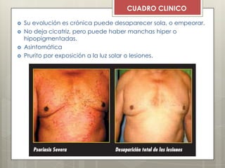  Su evolución es crónica puede desaparecer sola, o empeorar.
 No deja cicatriz, pero puede haber manchas hiper o
hipopigmentadas.
 Asintomática
 Prurito por exposición a la luz solar o lesiones.
CUADRO CLINICO
 