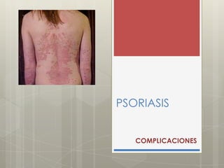 PSORIASIS
COMPLICACIONES
 