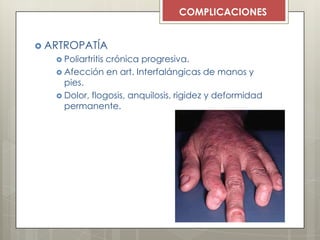  ARTROPATÍA
 Poliartritis crónica progresiva.
 Afección en art. Interfalángicas de manos y
pies.
 Dolor, flogosis, anquilosis, rigidez y deformidad
permanente.
COMPLICACIONES
 