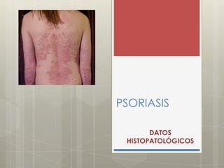 PSORIASIS
DATOS
HISTOPATOLÓGICOS
 