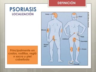 DEFINICIÓN
Principalmente en
codos, rodillas, regió
n sacra y piel
cabelluda
PSORIASIS
LOCALIZACIÓN
 
