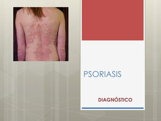 PSORIASIS
DIAGNÓSTICO
 