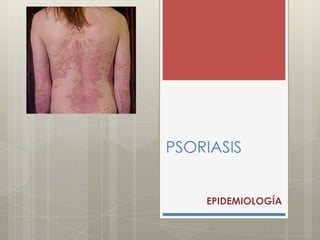 PSORIASIS
EPIDEMIOLOGÍA
 