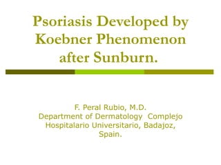 Psoriasis Developed by Koebner Phenomenon after  Sunburn .  F. Peral Rubio, M.D. Department of Dermatology  Complejo Hospitalario Universitario, Badajoz, Spain. 