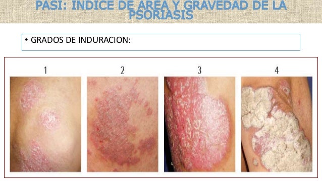 La calabaza a atopicheskom la dermatitis a los niños