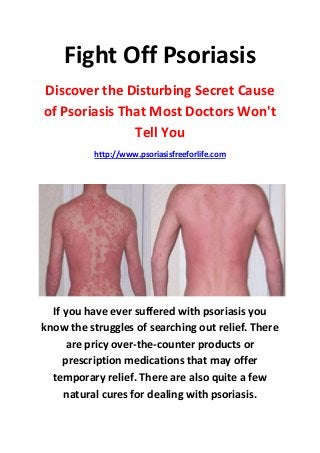 Fight Off Psoriasis
Discover the Disturbing Secret Cause
of Psoriasis That Most Doctors Won't
               Tell You
          http://www.psoriasisfreeforlife.com




  If you have ever suffered with psoriasis you
know the struggles of searching out relief. There
      are pricy over-the-counter products or
     prescription medications that may offer
  temporary relief. There are also quite a few
     natural cures for dealing with psoriasis.
 