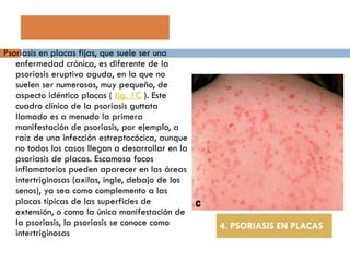 Psoriasis en placas fijas, que suele ser una enfermedad crónica, es diferente de la psoriasis eruptiva aguda, en la que no suelen ser numerosas, muy pequeño, de aspecto idéntico placas (  fig. 1C  ). Este cuadro clínico de la psoriasis guttata llamado es a menudo la primera manifestación de psoriasis, por ejemplo, a raíz de una infección estreptocócica, aunque no todos los casos llegan a desarrollar en la psoriasis de placas. Escamosa focos inflamatorios pueden aparecer en las áreas intertriginosas (axilas, ingle, debajo de los senos), ya sea como complemento a las placas típicas de las superficies de extensión, o como la única manifestación de la psoriasis, la psoriasis se conoce como intertriginosas 4. PSORIASIS EN PLACAS 