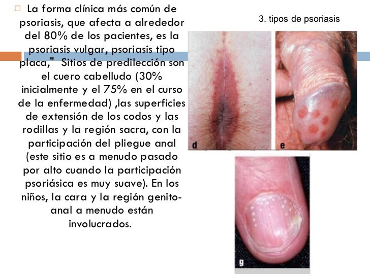La primera cebadura del mamón a atopicheskom la dermatitis