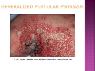  Three Cardinal Signs of Psoriatic Lesions 
 Plaque elevation 
 Erythema 
 Scale 
 Body Surface Area 
 