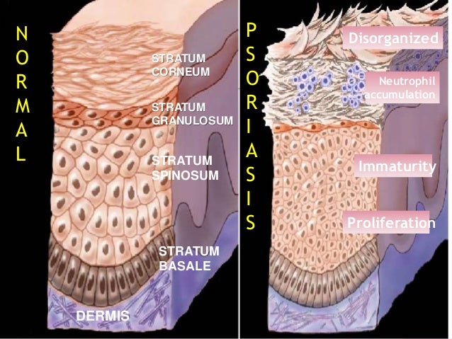 Psoriasis and Management in Primary Care