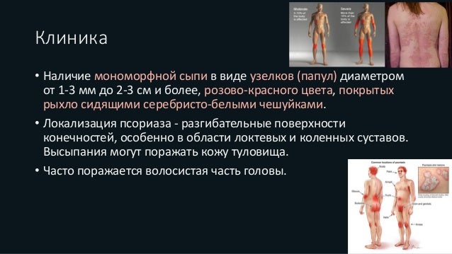 Первичная консультация для пациентов с проблемой псориаза 1500 рублей