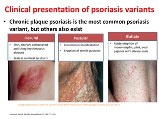 • Chronic plaque psoriasis is the most common psoriasis
variant, but others also exist
Clinical presentation of psoriasis variants
Flexural
• Thin, sharply demarcated
and shiny erythmatous
plaques
• Scale is minimal to absent
Pustular
• Uncommon manifestation
• Eruption of sterile pustules
Guttate
• Acute eruption of
monomorphic, pink, oval
papules with silvery scale
Ladizinski B et al. Adv Skin Wound Care 2013;26:271–284.
Images reproduced with the permission of the Primary Care Dermatology Society © PCDS 2015
 