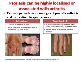 • Psoriasis patients can show signs of psoriatic arthritis
and be localised to specific areas
Psoriasis can be highly localised or
associated with arthritis
Palmoplantar
• Localised to the palms or soles
• Red, scaly plaques or patchy thickening of
entire surface of palm or sole
Psoriatic arthritis
• A painful, inflammatory condition of the
joints, sometimes leading to joint deformity
• Usually occurs in association with skin
psoriasis
DermNet New Zealand. Psoriasis. Available from: https://www.dermnetnz.org/topics/psoriasis. Last accessed: September 2018.
 