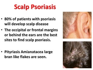 • 80% of patients with psoriasis
will develop scalp disease
• The occipital or frontal margins
or behind the ears are the best
sites to find scalp psoriasis.
• Pityriasis Amianatacea large
bran like flakes are seen.
Scalp Psoriasis
 