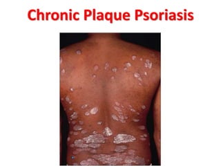 Chronic Plaque Psoriasis
 