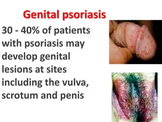 Genital psoriasis
30 - 40% of patients
with psoriasis may
develop genital
lesions at sites
including the vulva,
scrotum and penis
 