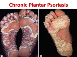 Chronic Plantar Psoriasis
 