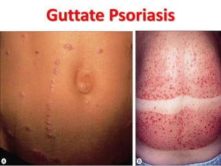 Guttate Psoriasis
 
