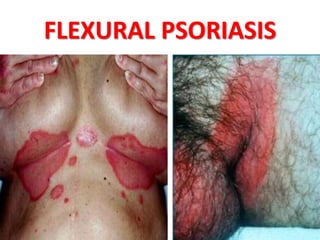 FLEXURAL PSORIASIS
 