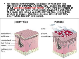 • Psoriasis is an inflammatory skin disease in which skin cells
replicate at an extremely rapid rate. New skin cells are produced
about eight times faster than normal--over several days instead of
a month--but the rate at which old cells slough off is unchanged.
This causes cells to build up on the skin's surface, forming thick
patches, or plaques, of red sores (lesions) covered with flaky,
silvery-white dead skin cells (scales).
 