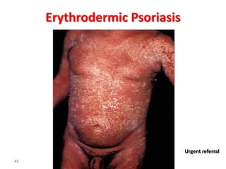 43
Erythrodermic Psoriasis
Urgent referral
 